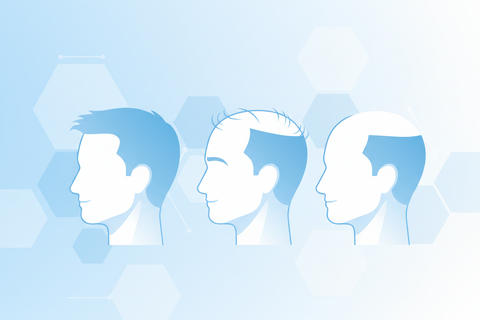 Male Pattern Baldness: A Man’s Guide